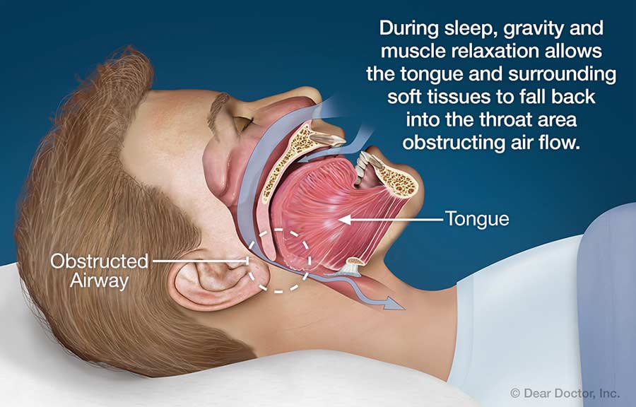 The best mattress for sleep apnea will help keep your airway open by properly supporting head and neck. Spine alignment is also important, so some degree of firmness is necessary. I also recommend the use of natural or hypo-allergenic materials for anyone with asthma, COPD, or other respiratory issues.